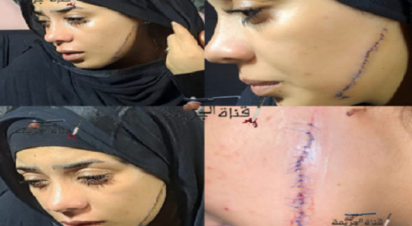 سيدة تشوه وجه عروس طليقها وتتفاخر عبر وسائل التواصل الإجتماعي