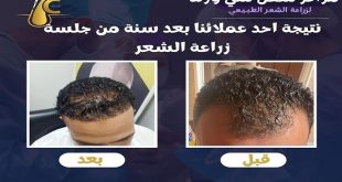 مراكز سفن سي وورلد لزراعة الشعر.. رقم واحد في مصر بثقة العملاء