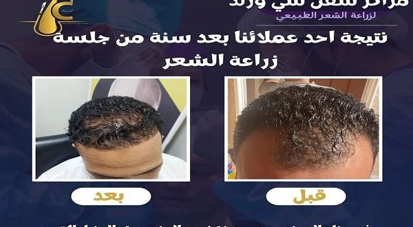 مراكز سفن سي وورلد لزراعة الشعر.. رقم واحد في مصر بثقة العملاء