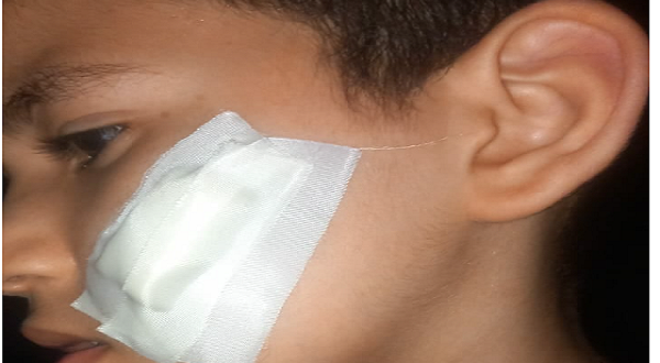 مأساة في الفصل: طفل يشوه زميله بـ"كتر" في حلوان