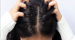 أفضل طرق التخلص من قشرة الرأس والحواجب