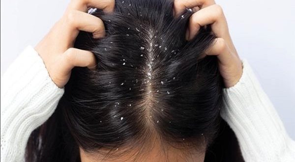 أفضل طرق التخلص من قشرة الرأس والحواجب