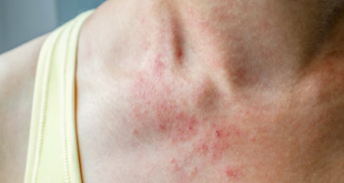 كيف تميز بين الحساسية ونزلة البرد والإنفلونزا وكوفيد-19 في الشتاء؟